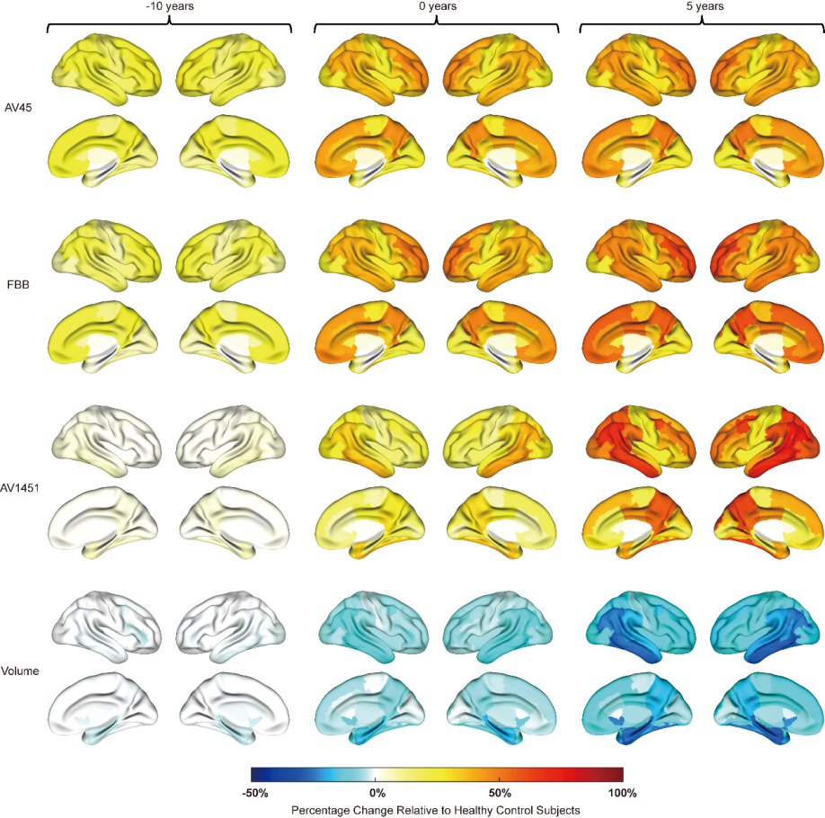 阿尔茨海默病个体化发病时间预测新方法